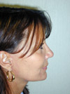 Facelift New York