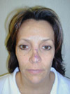 Facelift New York