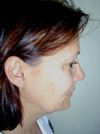 Facelift New York