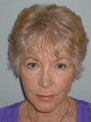 Facelift New York