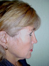 Facelift New York