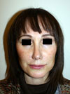 Nose Job NYC