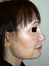 Nose Job NYC
