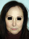 Nose Job NYC
