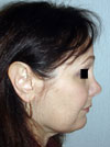 Nose Job NYC
