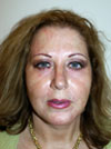 facelift before and after gallery