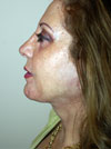 facelift before after pictures