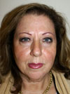 Facelift New York