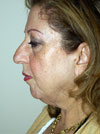 facelift before after picture