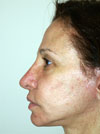 Nose Job NYC