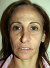 Nose Job NYC