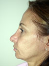 Nose Job NYC