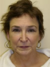 necklift before after picture