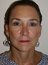 facelift before and after photo