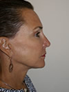 facelift before after photo