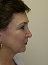facelift before and after photo