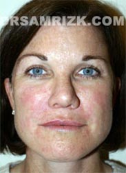 photo Female patient after Facelift