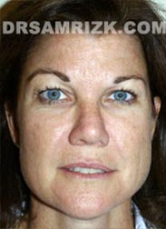 Female before Facelift - picture