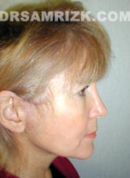 Female after Facelift