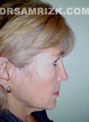 Female before Facelift