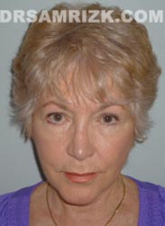photo Female after Facelift