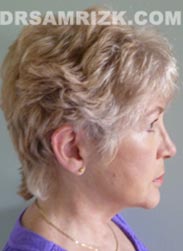 Female patient after Facelift