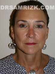 image female after Facelift procedure - front view