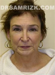 Facelift photography before