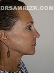 photo female after Facelift procedure - side view