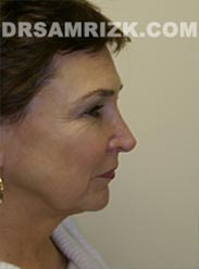 Female before Facelift - pic