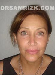 image Female after Facelift