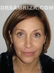 Female before Facelift - photo