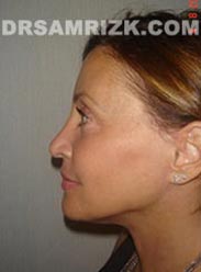 picture Female after Facelift