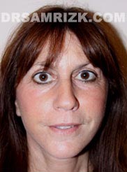 Female after Facelift - pic