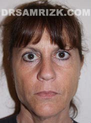 Female before Facelift - image