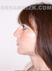 Female after Facelift and Necklift