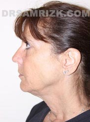 Female before Facelift and Necklift