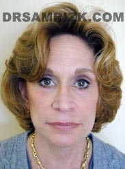 Female after Facelift - photo