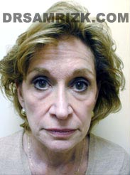 pic Female patient before Facelift