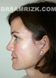 pic Female patient after Facelift procedure