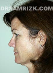 Female patient before Facelift procedure - picture