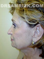 picture Female patient before Facelift