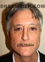 photo Male patient after Facelift