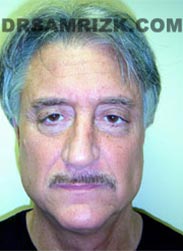 Male patient before Facelift