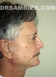 picture Male patient after Facelift