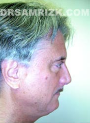 photo Male patient before Facelift