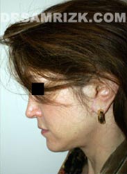 Female after Necklift procedure - photo