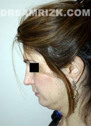 Female before Necklift procedure - photo