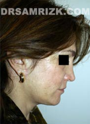 Female patient after Necklift procedure - photo
