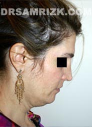 Female patient before Necklift procedure - image
